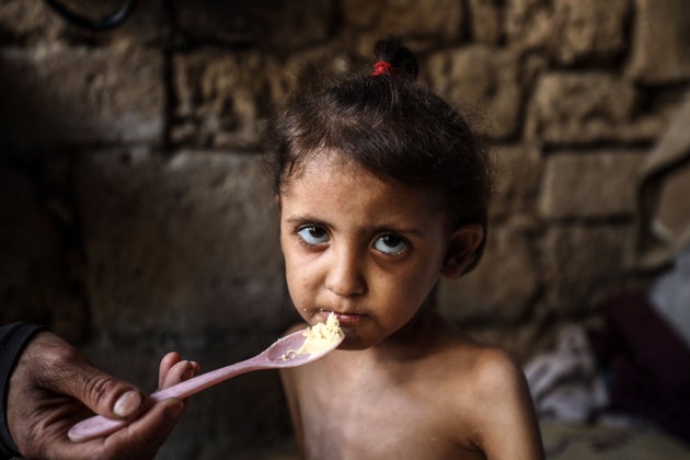 Islam Hajjaj feeds her 6-year-old malnourished daughter Najwa, at a shelter in central Gaza City, on May 11. Israel's total blockade of food and humanitarian aid has led to Palestinian children facing mass starvation.