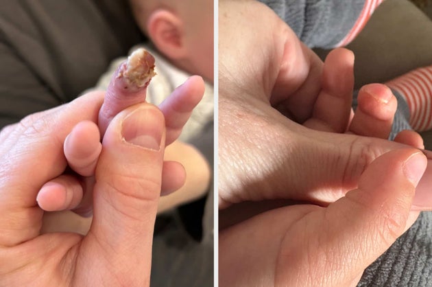 Her son's finger after the accident (left) and since healing fully (right).
