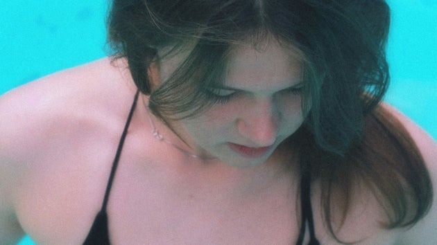 Woman with sunburn