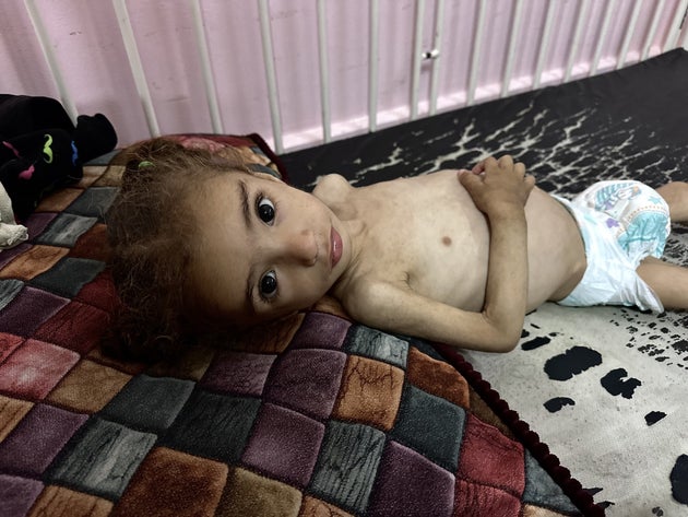 H 18 μηνών Μαγιάρ Ελ Αρκα νοσηλεύεται στο Νοσοκομείο Νάσερ στην Χαν Γιιουνίς (17 Μαϊου 2025). Στη Γάζα, λόγω του αποκλεισμού της ανθρωπιστικής βοήθειας από το Ισραήλ εδώ και δύο μήνες τα παιδιά παλεύουν με τον υποσιτισμό.