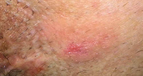 Groin Rash Reaction Female Groin Rash Itchy