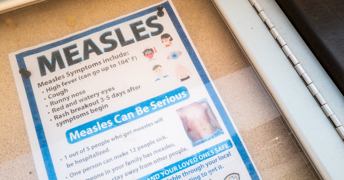 Measles Outbreak Hits Another State Measles Outbreak Hits Another State