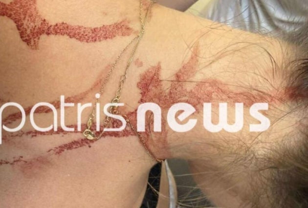 Αιματηρή συμπλοκή σημειώθηκε το μεσημέρι της Πέμπτης στην Αμαλιάδα μεταξύ δύο γυναικών. Μία από τις δύο άρπαξε ένα ψαλίδι και ξεκίνησε να κυνηγά μανιασμένα την άλλη γυναίκα.