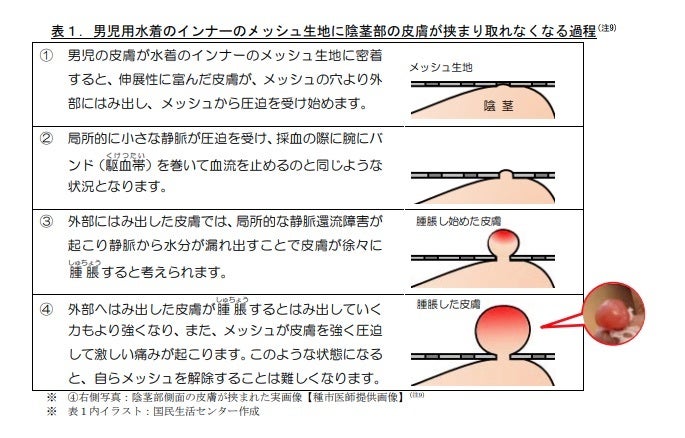陰茎部の皮膚が挟まり取れなくなる過程