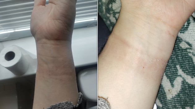 The flaky, pink rash