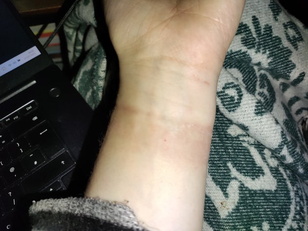 Rash on my wrist under fitness tracker strap area