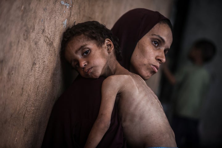 2-year-old Palestinian Yezen Abu Ful, whose health has deteriorated due to lack of access to food and nutritional supplements, is seen with his mother in the Al-Shati Refugee Camp in Gaza Strip on July 24, 2025.