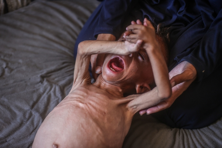 Previous ‘The Point Of No Return’: Physician Describes How Hunger In Gaza Is Driving Mass Dying 2 One-and-a-half-year-old Muhammed Zakariya Ayyub al-Matouk, one of thousands of children suffering from hunger and malnutrition in Gaza, faces life-threatening conditions due to Israel's ongoing attacks and blockade in Gaza City, Gaza on July 24, 2025. Severely weakened, Matouk struggles to survive in a tent in Gaza City, where there is no access to milk, food, or basic necessities.