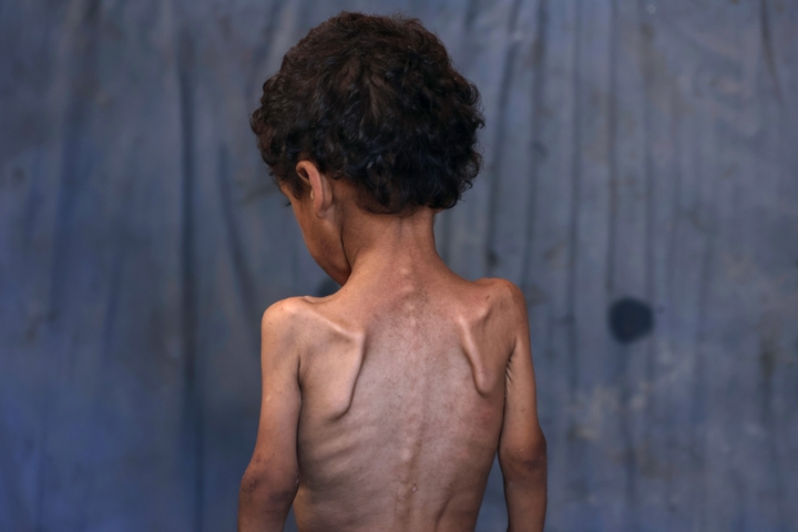 Yazan, a malnourished 2-year-old Palestinian boy, stands with his back turned in his family's damaged home in the Al-Shati refugee camp, west of Gaza City, on July 23, 2025. More than 100 aid organisations and human rights groups warned on Wednesday that "mass starvation" was spreading in Gaza, as the United States said its top envoy was heading to Europe for talks on a possible ceasefire and aid corridor.