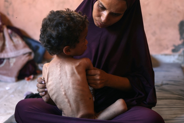 Previous ‘The Point Of No Return’: Physician Describes How Hunger In Gaza Is Driving Mass Dying 3 Naeema, a 30-year-old Palestinian mother, sits with her malnourished 2-year-old son Yazan in their damaged home in the Al-Shati refugee camp, west of Gaza City, on July 23, 2025. More than 100 aid organisations and human rights groups warned on Wednesday that "mass starvation" was spreading in Gaza, as the United States said its top envoy was heading to Europe for talks on a possible ceasefire and aid corridor.