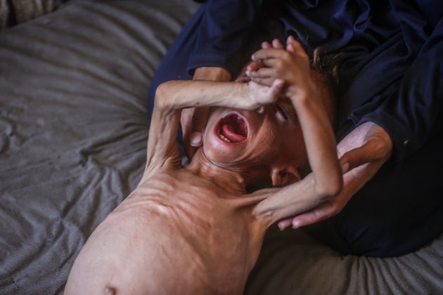 1歳半のムハンマド・ザカリヤ・アイユーブ・アル＝マトゥークくん。ガザで飢餓と栄養失調に苦しむ何千人もの子どもの一人だ。極度に衰弱したマトゥークは、ミルク、食料、基本的な生活必需品が一切手に入らないガザのテントで生き延びようと必死に闘っている