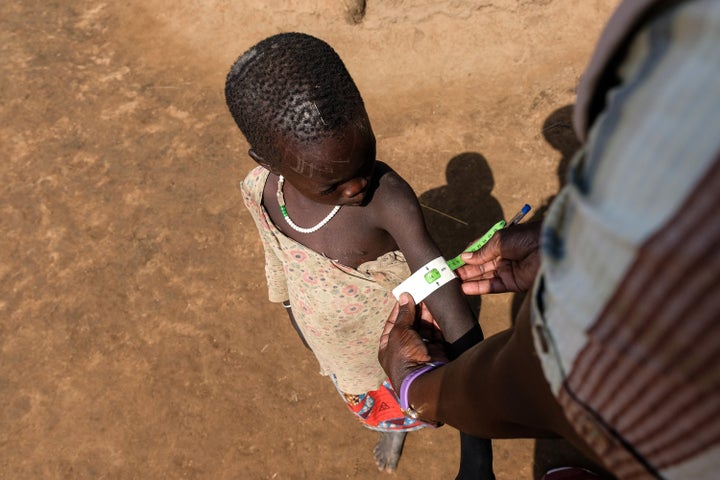 A health worker on July 23 measures a child's arm circumference in north-eastern Uganda, which has the highest rates of food insecurity and malnutrition within the East African country. Trump in January ordered the defunding of USAID, which provided food aid to the region.
