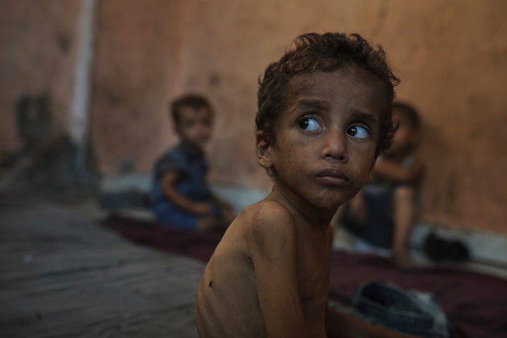 Yazan Abu Ful, a 2-year-old malnourished child, sits at his family home in the Shati refugee camp in Gaza City on Wednesday, July 23, 2025. (AP Photo/Jehad Alshrafi)