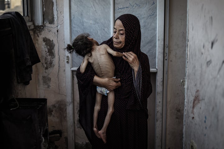 Misk al-Madhoun, six years old, who weighs less than 9 pounds, fights both with cerebral atrophy and severe malnutrition caused by hunger in the city of Gaza on Thursday.