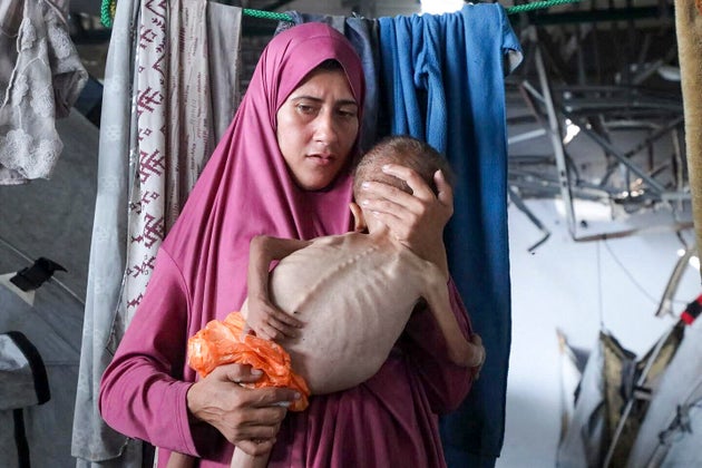 深刻な栄養失調に陥ったパレスチナ人の赤ちゃん。ガザ地区の避難所で撮影（2025年8月4日）