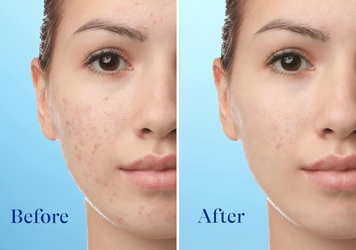 Adapalene Anti Aging: Unlock Youthful Skin with Proven Results