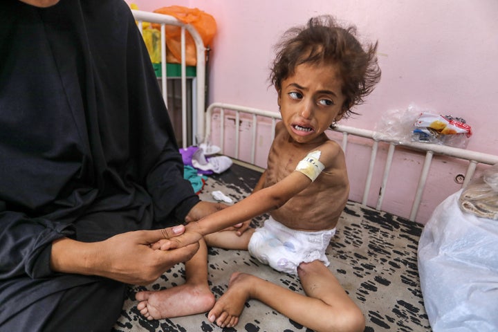 A malnourished Palestinian child is being treated at Nasser Hospital, which is operating with limited resources due to the lack of baby formula and medicine, in Khan Younis, Gaza, on Aug. 23, 2025.