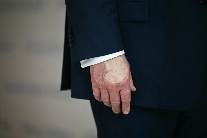 Trump continues to seemingly apply makeup or medicinal coverage of some kind to his right hand to cover markings, as seen on Aug. 22, 2025. Now his left hand has a similar-looking bruise.