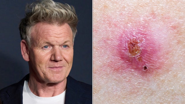 a basal cell carcinoma on the right