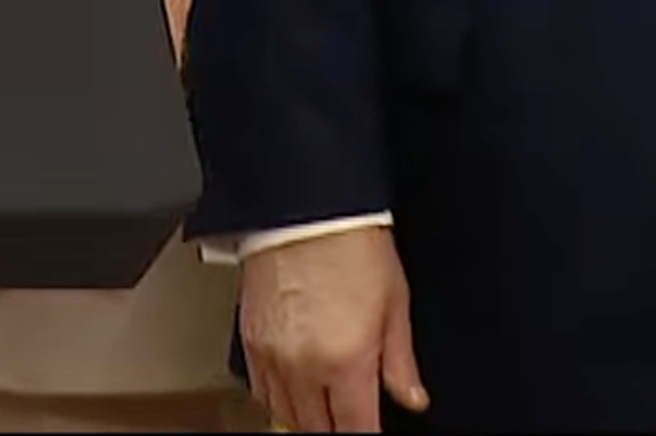 Trump's Hand Is Obviously Bruised