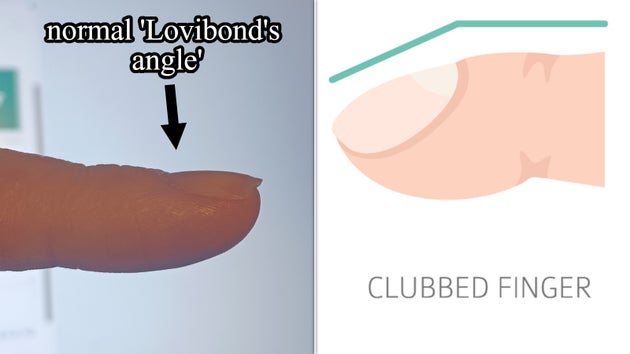 Normal Lovibond's angle vs clubbed fingernail
