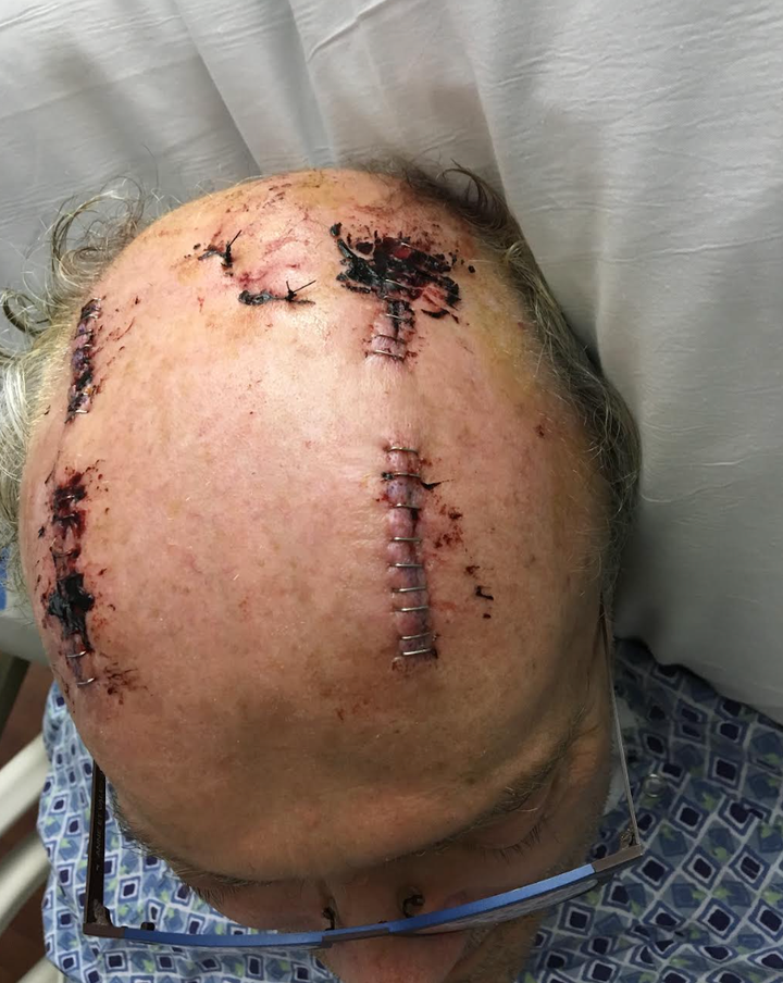 The author in the hospital after his brain surgery.