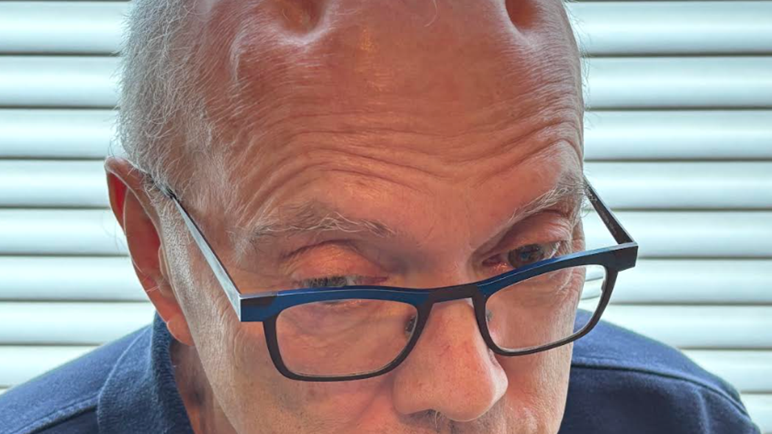 I Developed 4 Severe Dents In My Head — And What Happened Next Left Me Speechless I Developed 4 Severe Dents In My Head — And What Happened Next Left Me Speechless