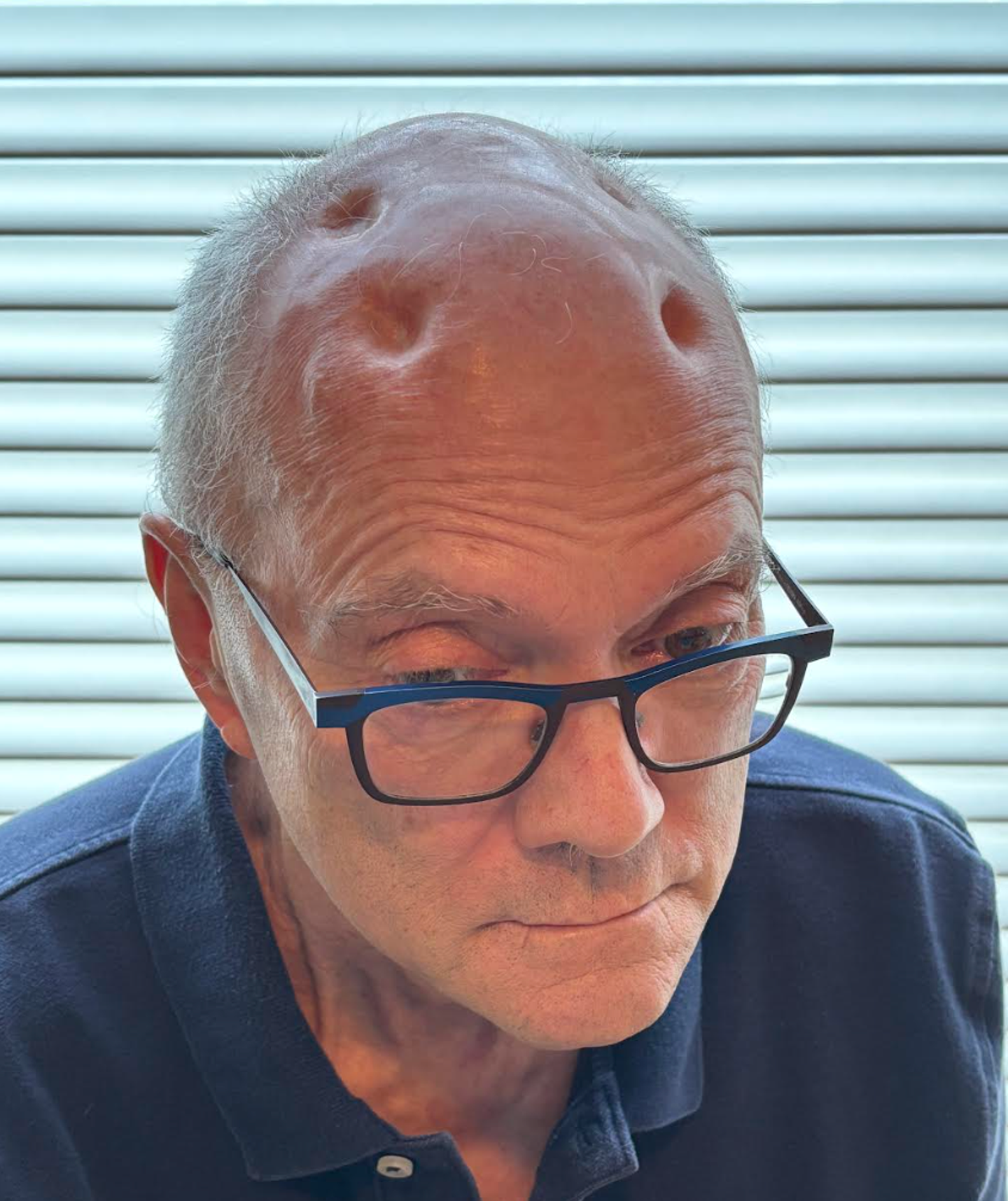 Dented Rounds Brain Surgery Led To 4 Head Dents: The Surprising Aftermath | HuffPost ...