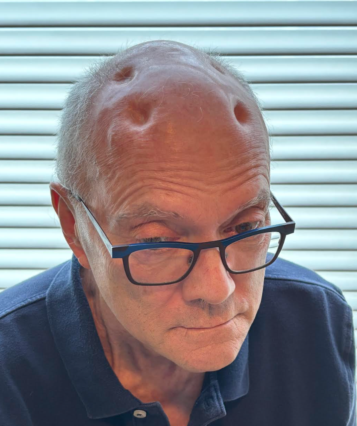 A current photo of the author showing the four "holes" in his head.