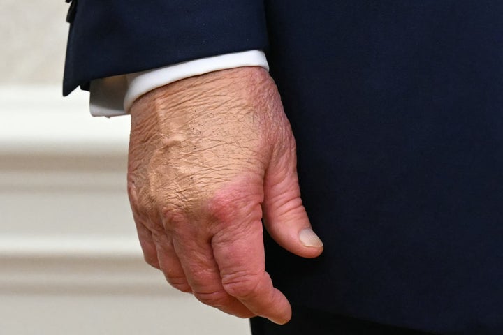 A close-up shows US President Donald Trump's right hand after he announced a deal on drug pricing at the Oval Office of the White House in Washington, DC, on October 10, 2025. Trump announced a lowering in drug prices with a deal with drug maker AstraZeneca. (Photo by SAUL LOEB / AFP) (Photo by SAUL LOEB/AFP via Getty Images) 