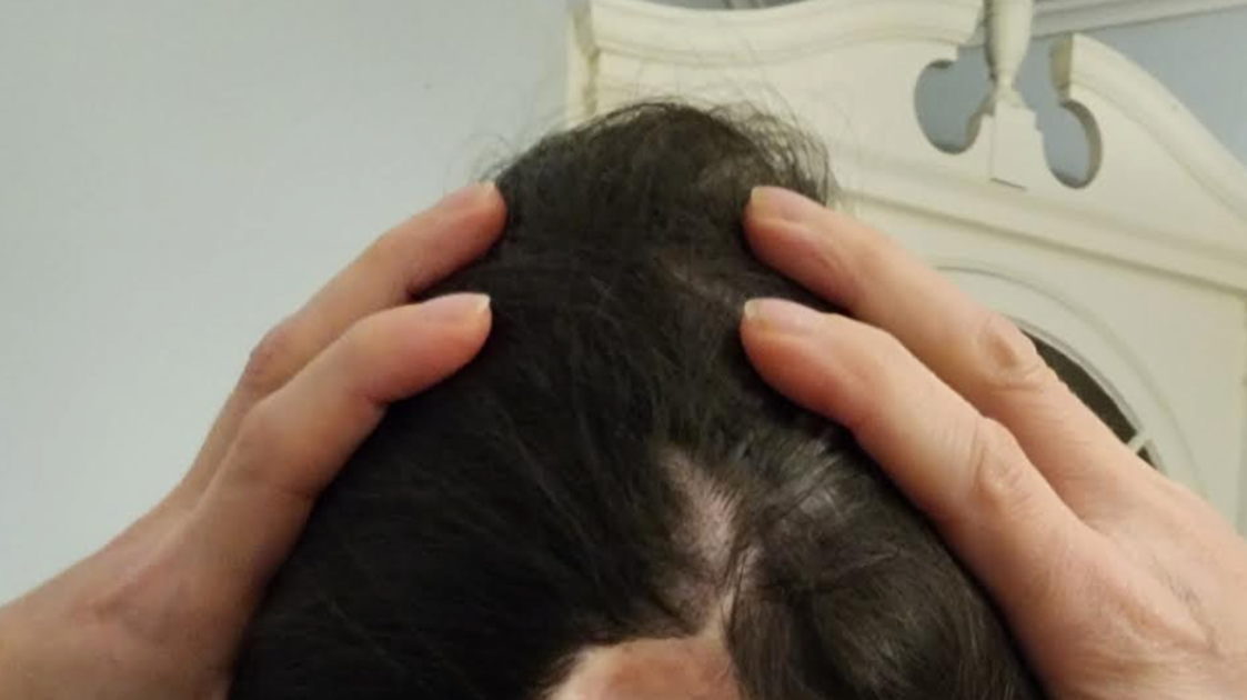 I Have A Hole The Size Of A Lime In The Back Of My Head. I’m Finally Ready To Talk About It. I Have A Hole The Size Of A Lime In The Back Of My Head. I’m Finally Ready To Talk About It.