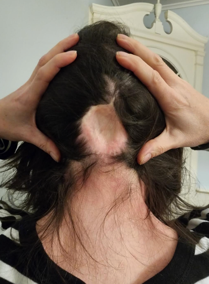 This is the photo that the author submitted to accompany her melanoma community profile. It was the first time she ever photographed her scar.