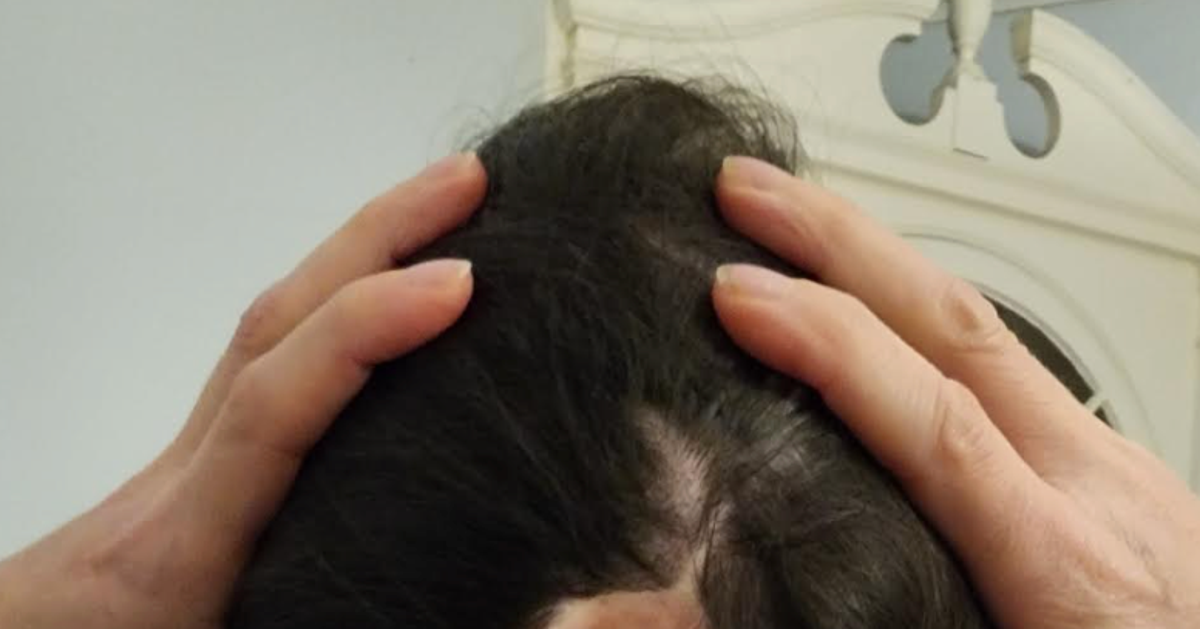 I've Been Hiding A Lime-Size Hole In The Back Of My Head For 30 Years