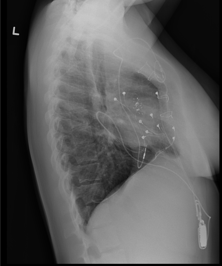 "This is a chest X-ray from 2024 — you can see the little 'clam shells' in my heart (they look like fireworks!) that help keep my pulmonary valve open. You’ll also see my sternal wires from my last open-heart surgery back in 2010, and all the capped wires from my old pacemakers (they can’t remove those, so they just stay in there)."