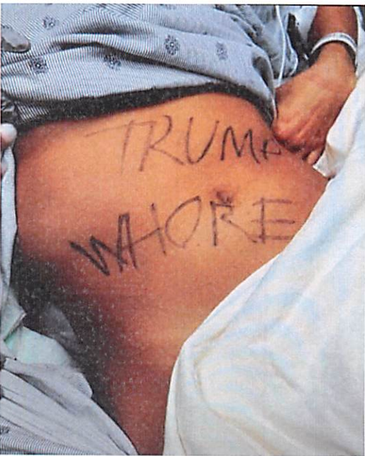 The suspect said attackers scrawled "TRUMP WHORE" on her stomach in an incident officials now say was a hoax.
