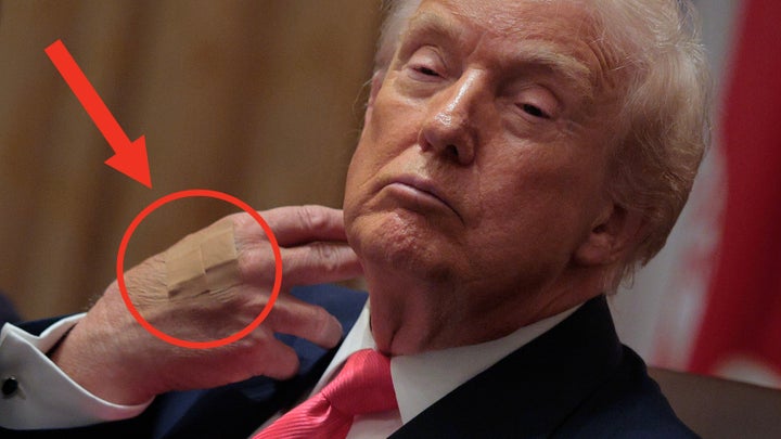 A large bandage covers a persistent bruise on Trump's right hand, surrounded by red.