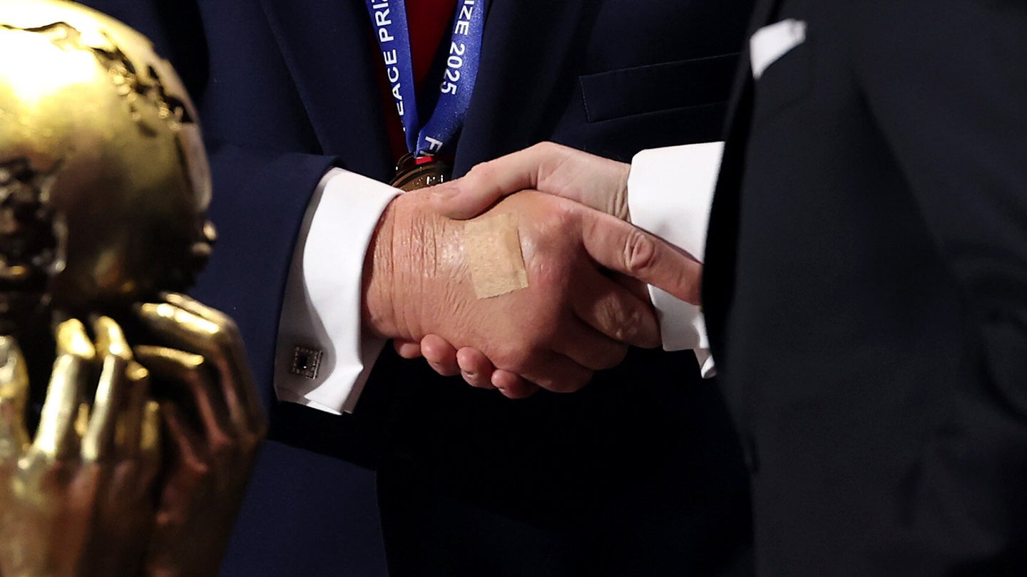 Trump's Bruised Hand Is Looking Pretty Swollen | HuffPost Latest News