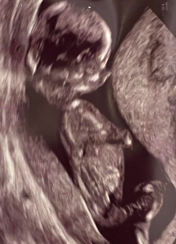 An ultrasound photo of the author's daughter at 12 weeks gestation.