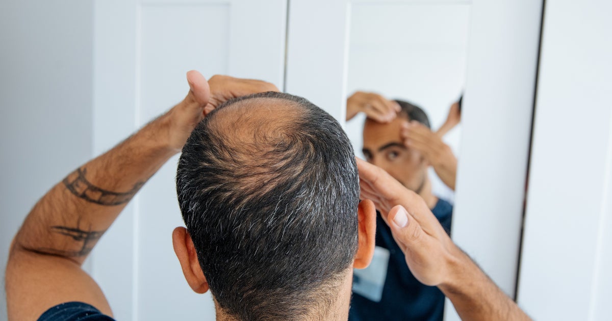 Men Going Bald Are Turning To Reddit For A Massive Confidence Boost
