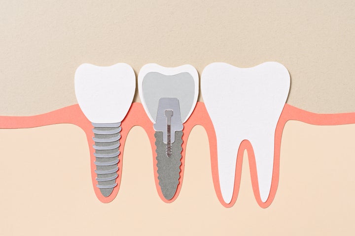 If you must eat before an appointment, try to time it at least one hour before your cleaning.