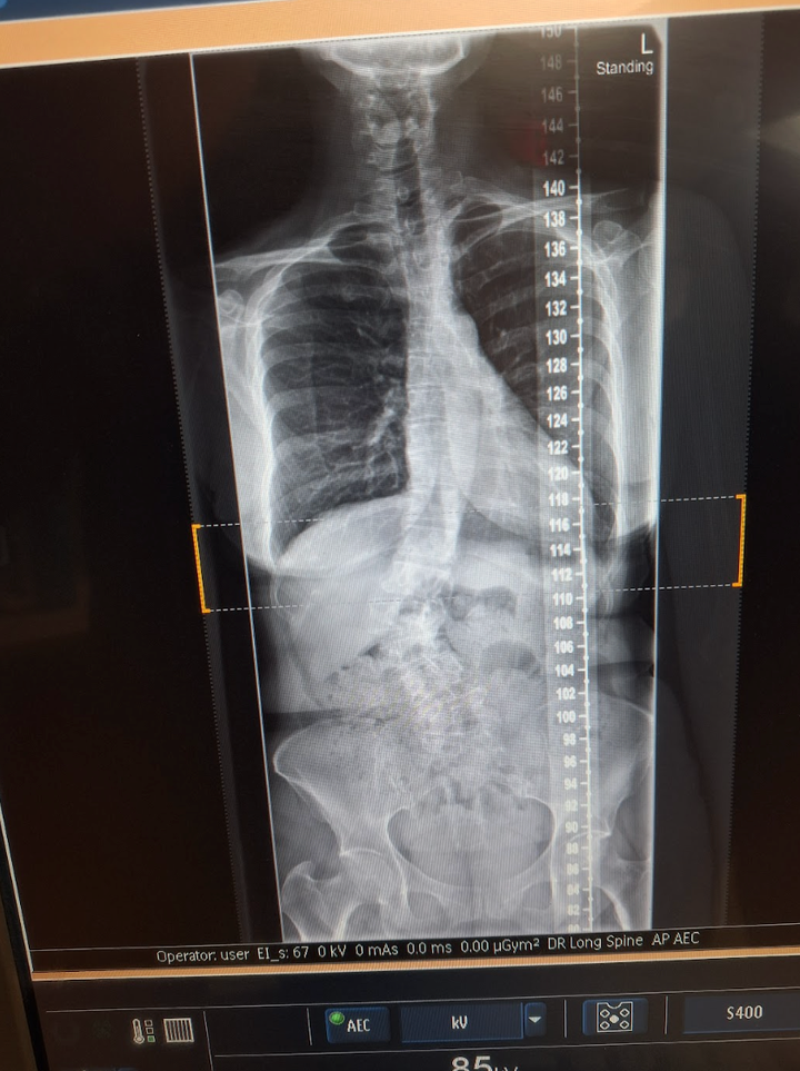 An X-ray of the author's spine taken in 2023.