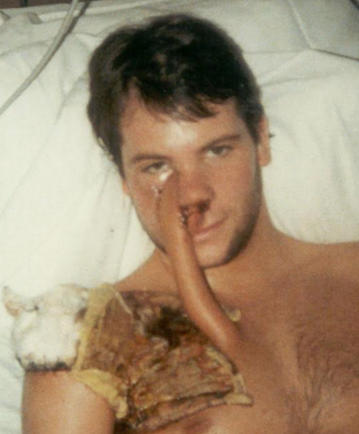 The author after surgery (1985).