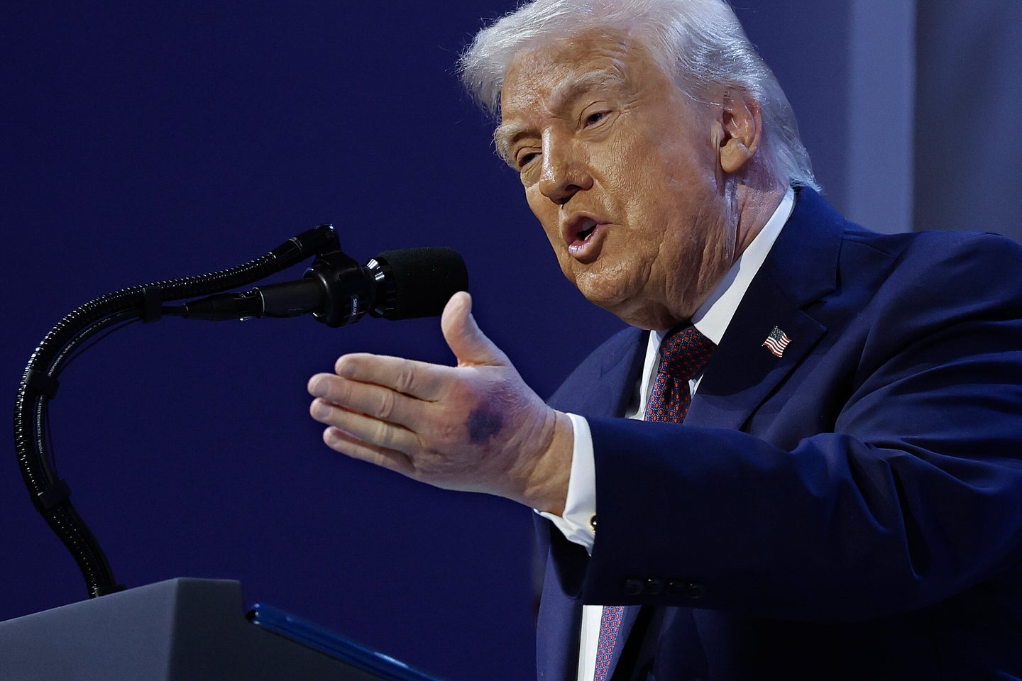 Donald Trump Has Yet Another Hand Bruise -- And A Sketchy Excuse ...