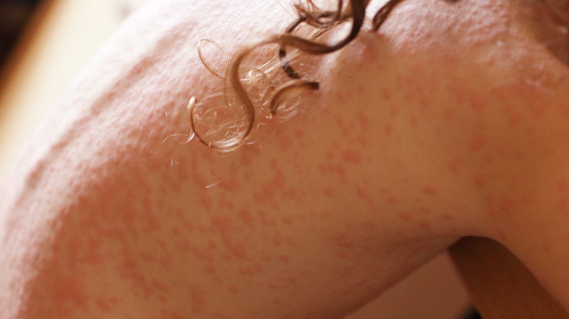 UK, 5 Other Nations Lose Their Measles Elimination Status