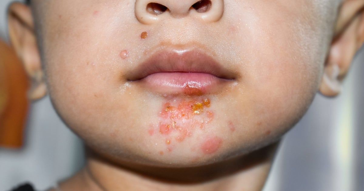 Pharmacist Urges Public To Check For Often Misdiagnosed Skin Infection