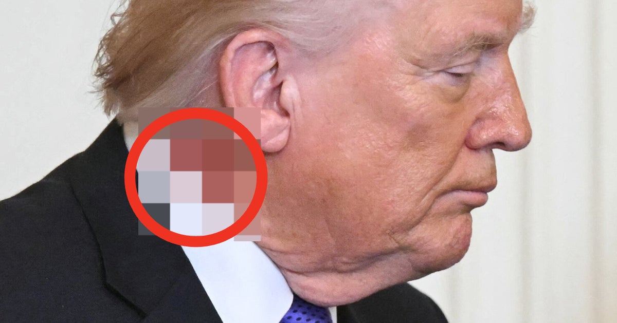 Looks Like President Trump Has Some Sort Of Gnarly Neck Rash