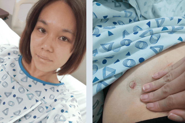 梶谷さんがアメリカで不妊手術を受けた際の写真。手術の傷跡は、術後1年ごろには梶谷さん本人が見てもわからない程度に回復した。