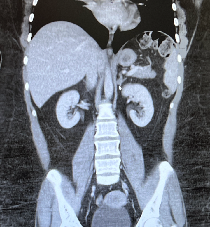 The author's mom took this photo of the author's CT scan.