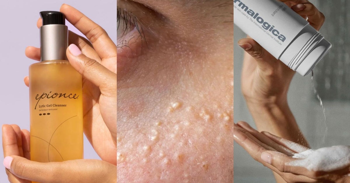 There's A Name For Those White Pesky Bumps Under Your Eyes — Here's What You Can Do About Them