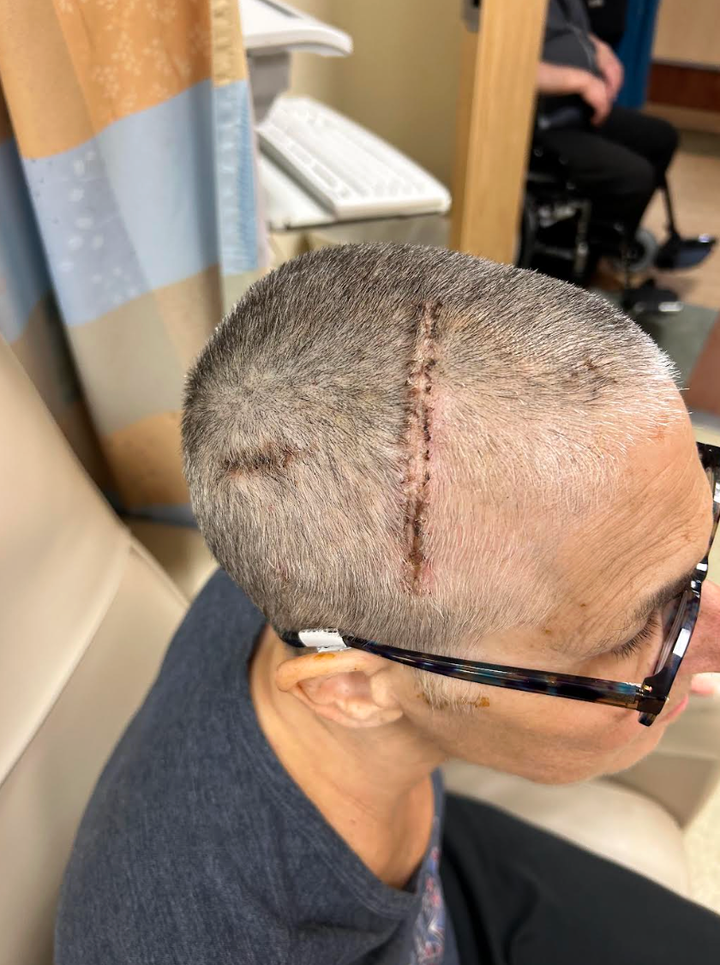 The author directly after she had 18 staples removed from her head. "Ultimately, I had three craniotomies to remove the subdural hematomas, a burr hole surgery to drain blood from my brain, and a laminoplasty on my back to repair my spinal column and stop the leak," she writes. "I am forever thankful to my neurosurgeon Dr. Matthew Bender who is well-versed in CSF leaks."